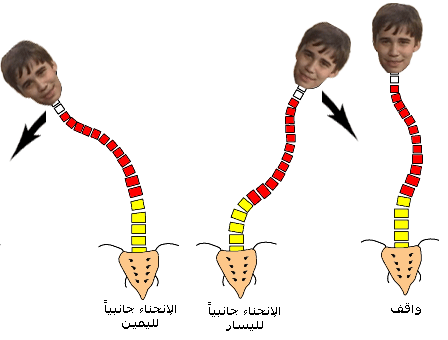 Scoliosis Scoliosis (14).gif